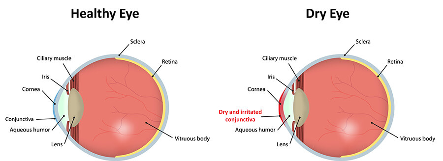 Chart Illustrating a Healthy Eye Vs One Experiencing Dry Eye