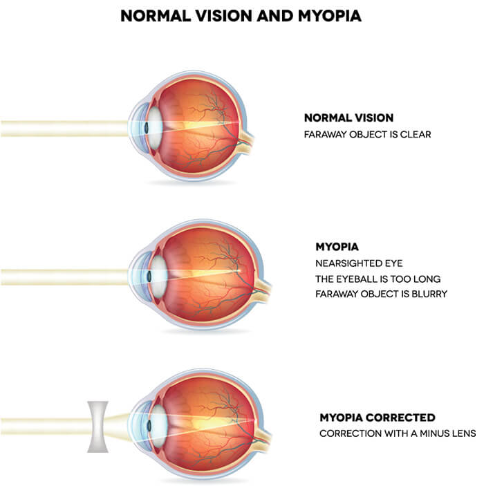 Chart Illustrating How Myopia Affects an Eye